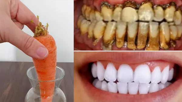 Fogfehérítés mindössze 2 perc alatt – a sárgulást és a lerakódott fogkövet tejfehér és ragyogóvá varázsolja