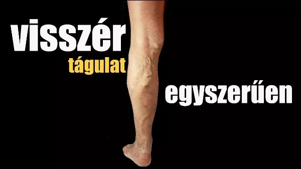 Visszértágulat - hogyan szüntetheted meg nyom nélkül?