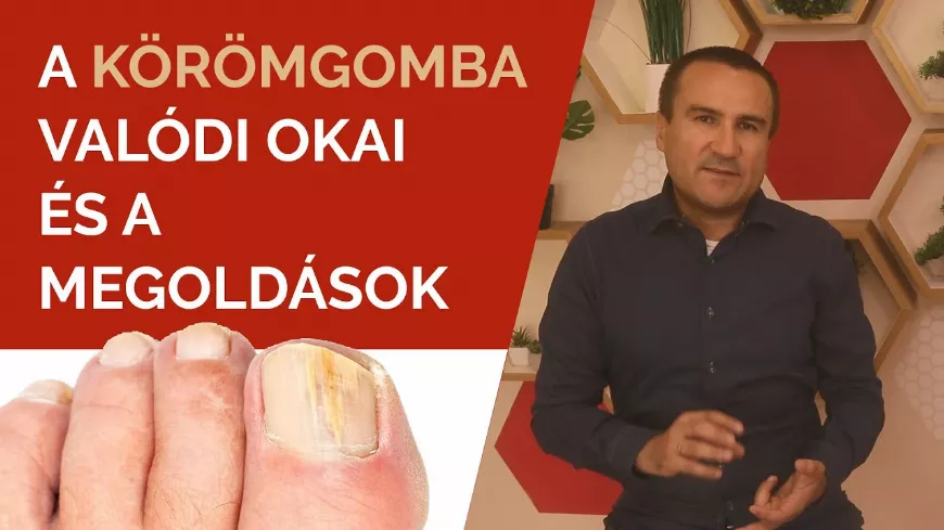 Körömgomba kialakulásának valódi okai. Körömgomba tünetei, körömgomba elleni szerek, kezelése házilag. 