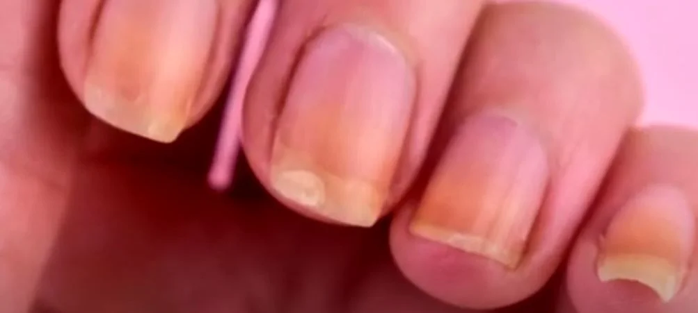 köröm szín fertőzés gomba betegség